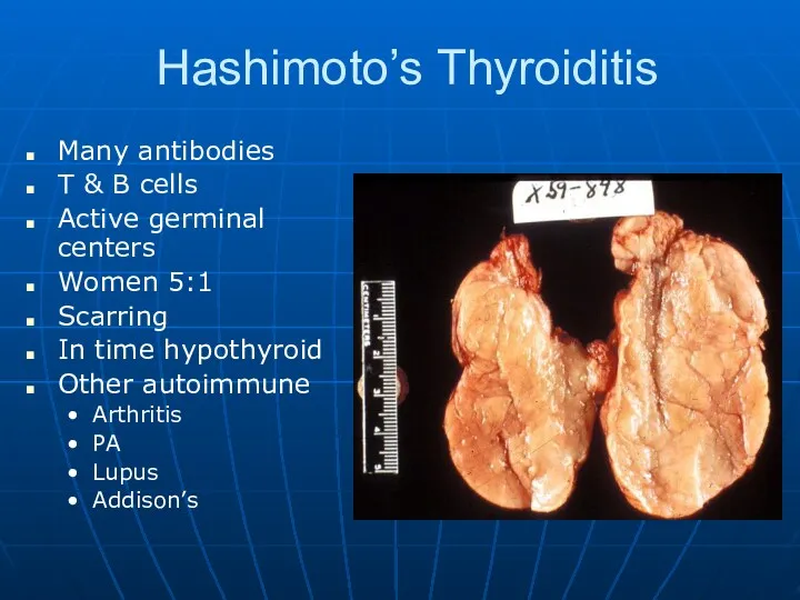 Hashimoto’s Thyroiditis Many antibodies T & B cells Active germinal