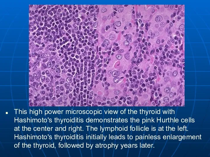 This high power microscopic view of the thyroid with Hashimoto's