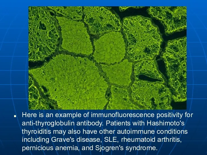 Here is an example of immunofluorescence positivity for anti-thyroglobulin antibody.