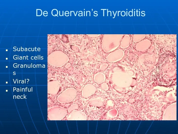 De Quervain’s Thyroiditis Subacute Giant cells Granulomas Viral? Painful neck