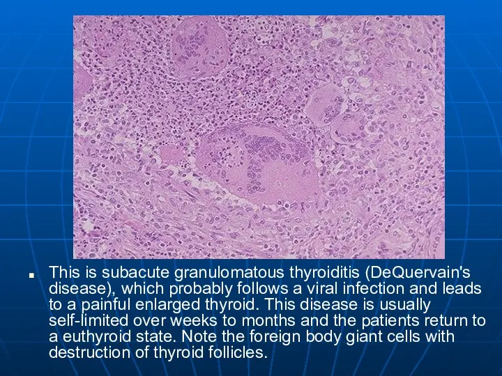 This is subacute granulomatous thyroiditis (DeQuervain's disease), which probably follows