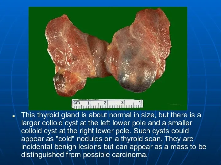 This thyroid gland is about normal in size, but there