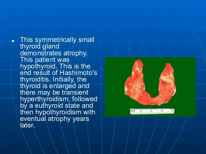 This symmetrically small thyroid gland demonstrates atrophy. This patient was