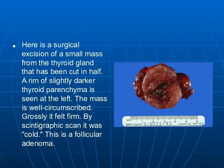 Here is a surgical excision of a small mass from