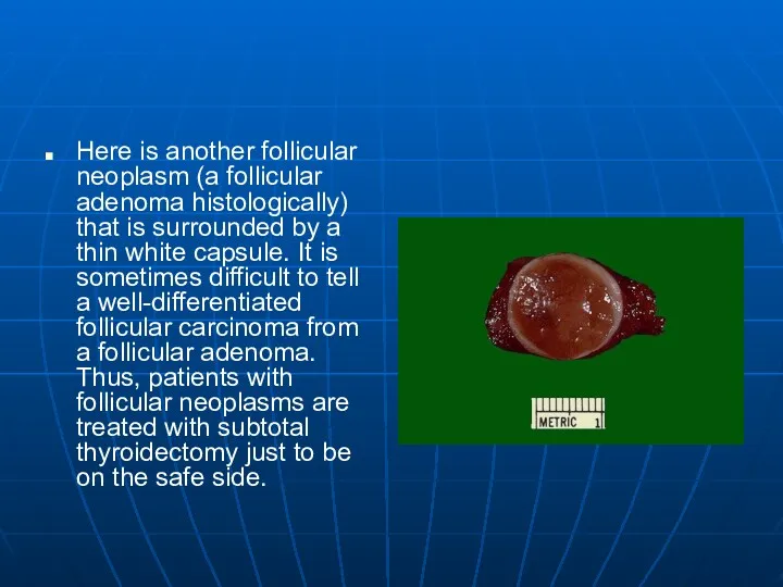 Here is another follicular neoplasm (a follicular adenoma histologically) that