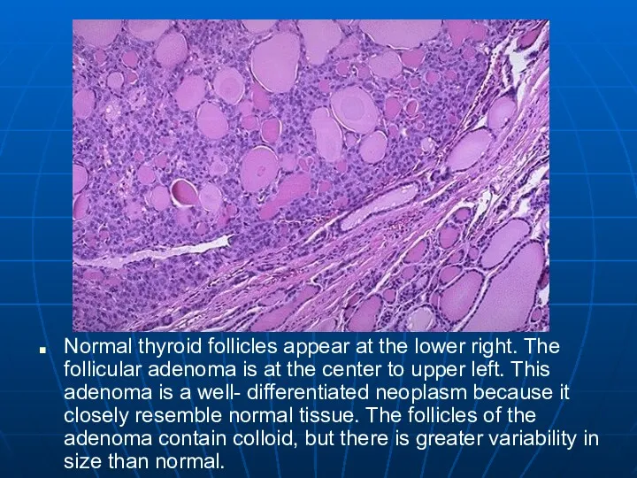 Normal thyroid follicles appear at the lower right. The follicular