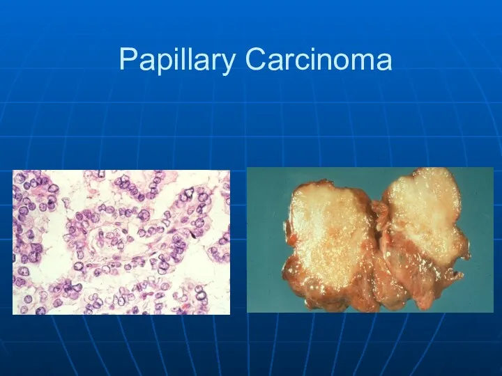 Papillary Carcinoma