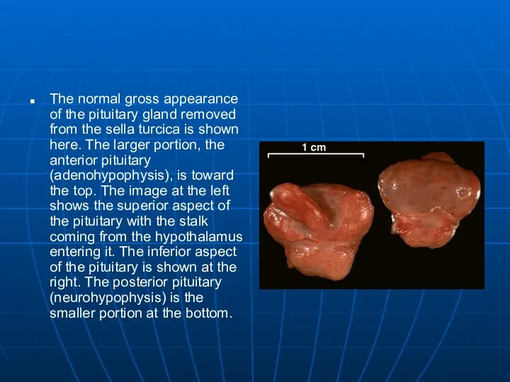 The normal gross appearance of the pituitary gland removed from