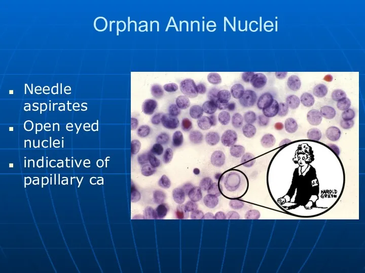 Orphan Annie Nuclei Needle aspirates Open eyed nuclei indicative of papillary ca