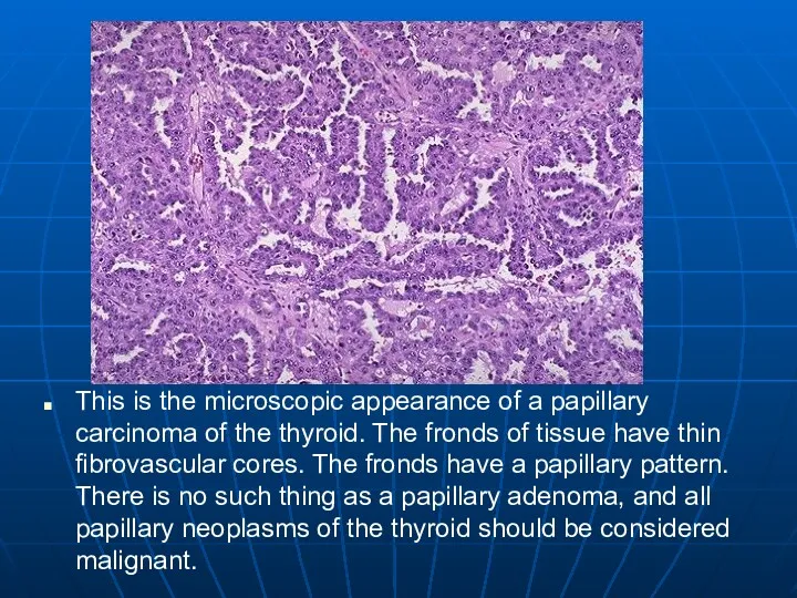 This is the microscopic appearance of a papillary carcinoma of