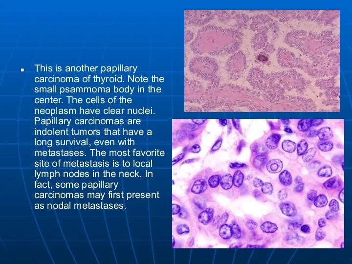 This is another papillary carcinoma of thyroid. Note the small