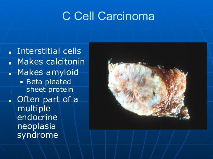 C Cell Carcinoma Interstitial cells Makes calcitonin Makes amyloid Beta