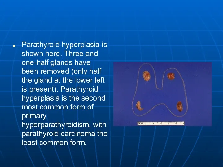 Parathyroid hyperplasia is shown here. Three and one-half glands have