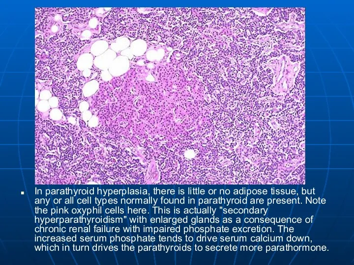 In parathyroid hyperplasia, there is little or no adipose tissue,