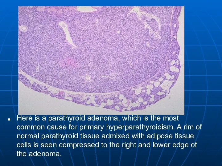 Here is a parathyroid adenoma, which is the most common