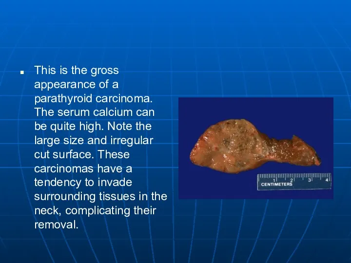 This is the gross appearance of a parathyroid carcinoma. The