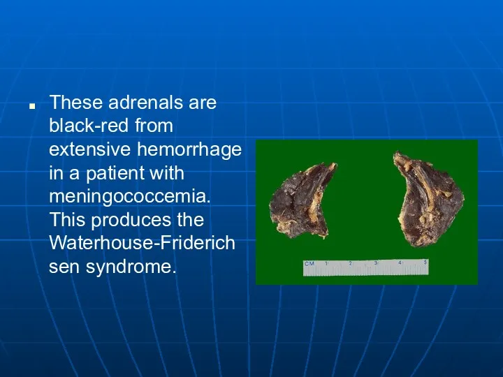 These adrenals are black-red from extensive hemorrhage in a patient