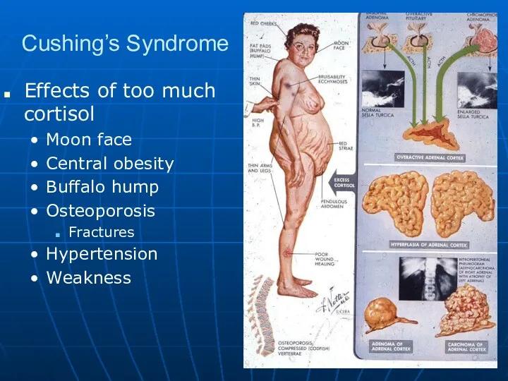 Cushing’s Syndrome Effects of too much cortisol Moon face Central