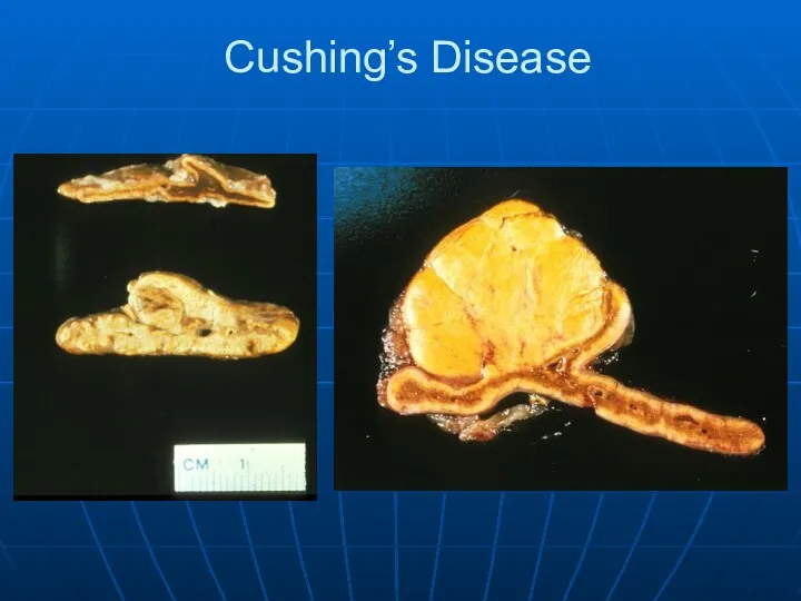 Cushing’s Disease