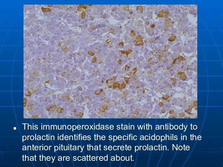 This immunoperoxidase stain with antibody to prolactin identifies the specific