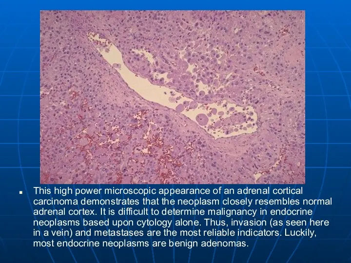 This high power microscopic appearance of an adrenal cortical carcinoma