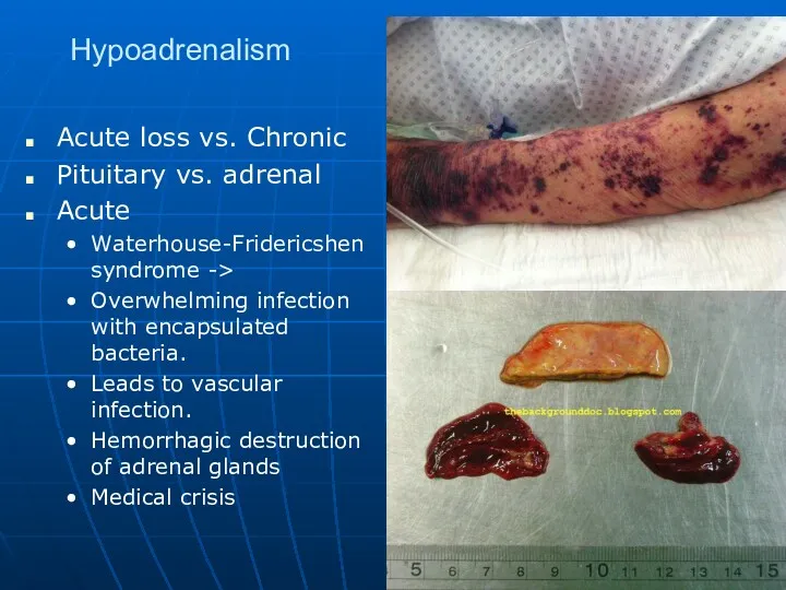 Hypoadrenalism Acute loss vs. Chronic Pituitary vs. adrenal Acute Waterhouse-Fridericshen