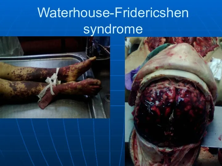 Waterhouse-Fridericshen syndrome