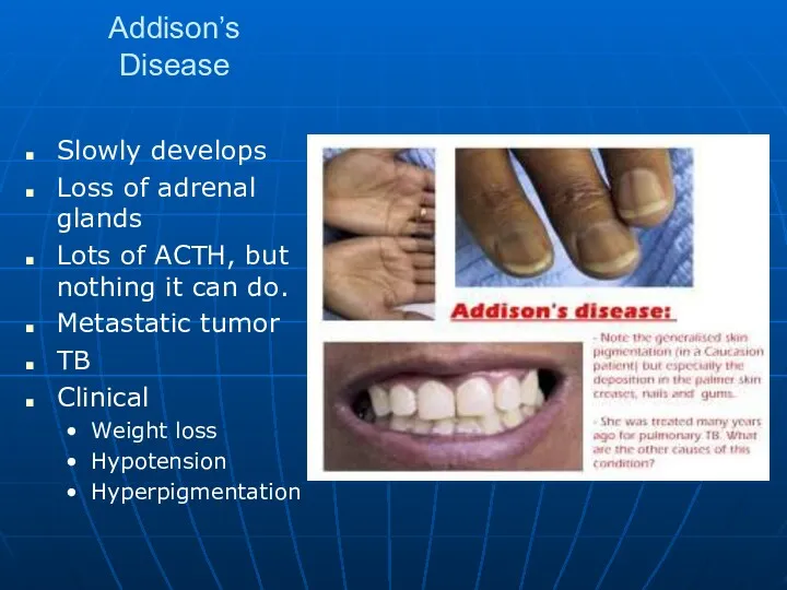 Addison’s Disease Slowly develops Loss of adrenal glands Lots of