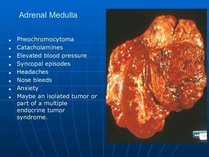 Adrenal Medulla Pheochromocytoma Catacholamines Elevated blood pressure Syncopal episodes Headaches