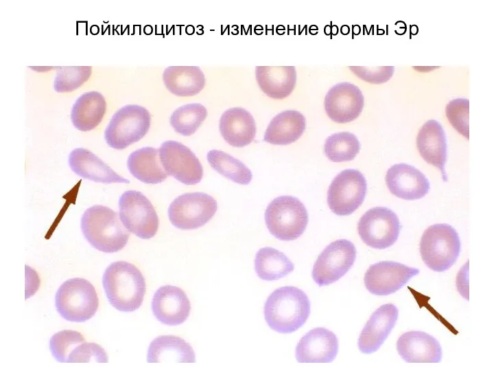 Пойкилоцитоз - изменение формы Эр