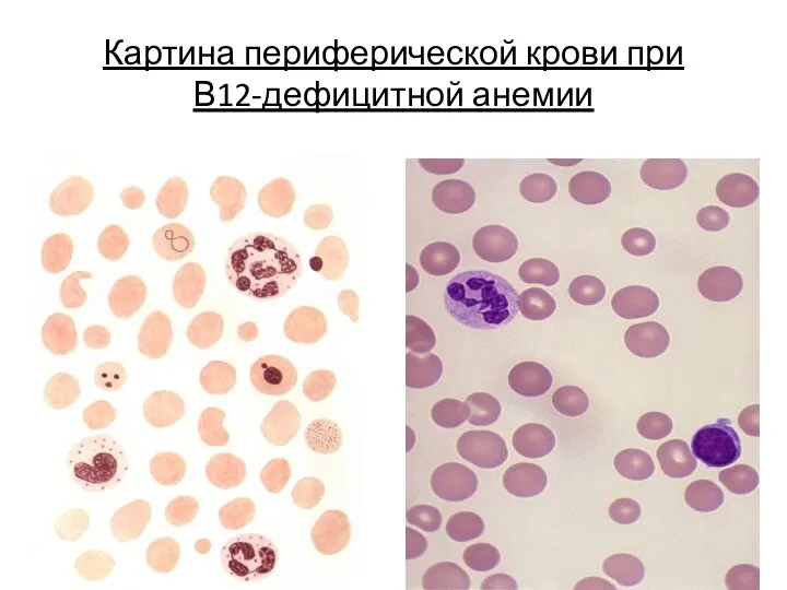 Картина периферической крови при В12-дефицитной анемии