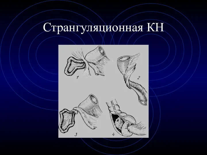 Странгуляционная КН