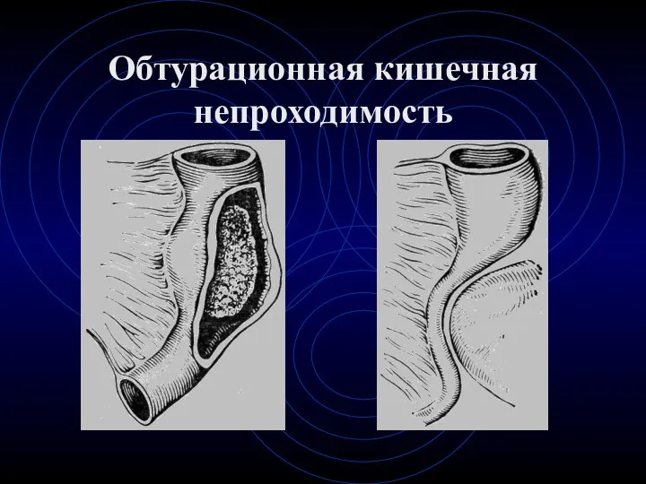 Обтурационная кишечная непроходимость