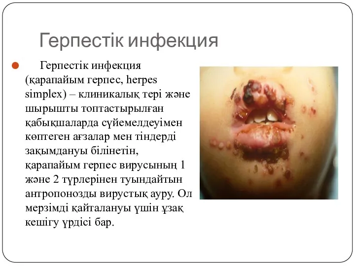 Герпестік инфекция Герпестік инфекция (қарапайым герпес, herpes simplex) – клиникалық