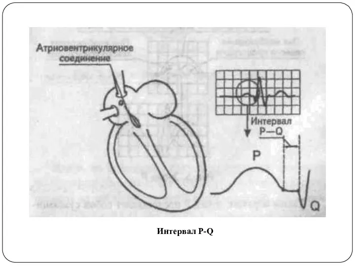 Интервал Р-Q