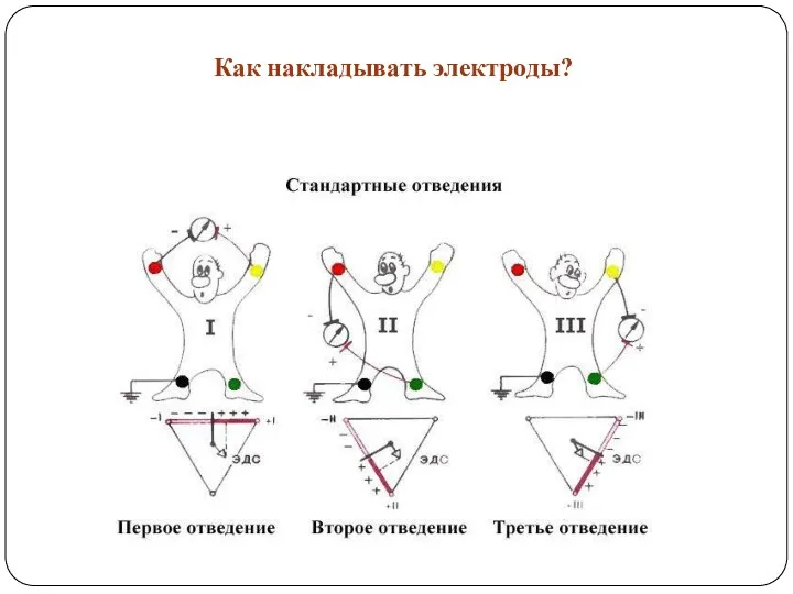 Как накладывать электроды?