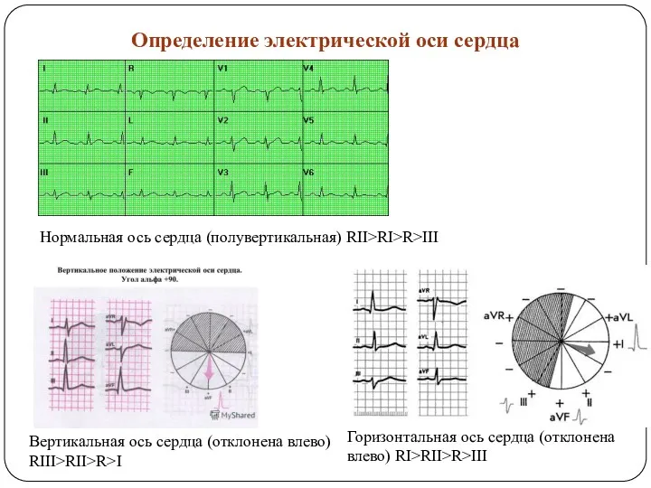 Определение электрической оси сердца Нормальная ось сердца (полувертикальная) RII>RI>R>III Горизонтальная