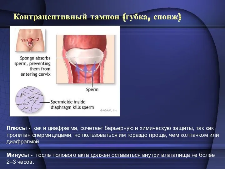 Контрацептивный тампон (губка, спонж) Плюсы - как и диафрагма, сочетает