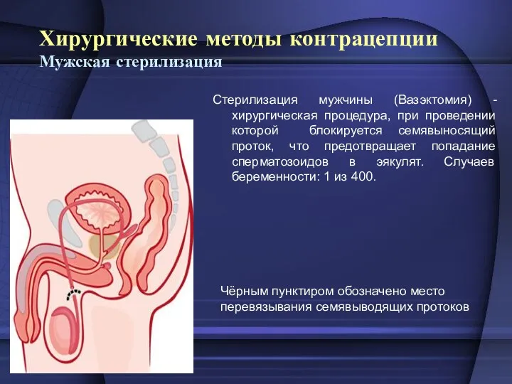 Хирургические методы контрацепции Мужская стерилизация Стерилизация мужчины (Вазэктомия) - хирургическая
