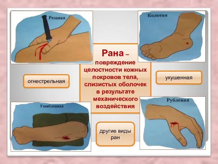 Рана – повреждение целостности кожных покровов тела, слизистых оболочек в