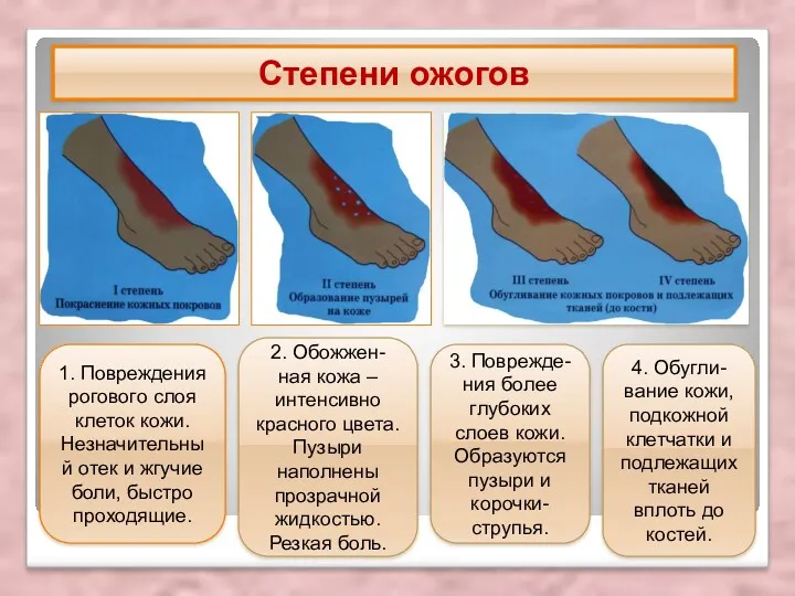 Степени ожогов 1. Повреждения рогового слоя клеток кожи. Незначительный отек