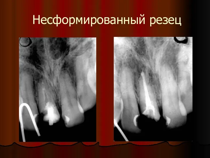 Несформированный резец