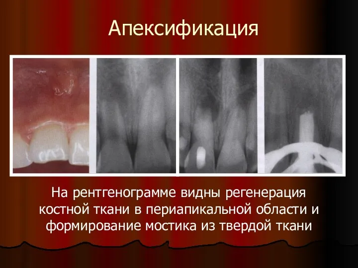 Апексификация На рентгенограмме видны регенерация костной ткани в периапикальной области и формирование мостика из твердой ткани