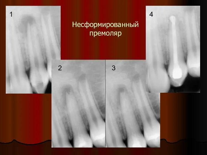 Несформированный премоляр 1 2 3 4