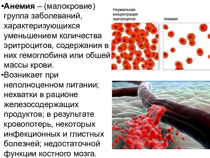 Анемия – (малокровие) группа заболеваний, характеризующихся уменьшением количества эритроцитов, содержания