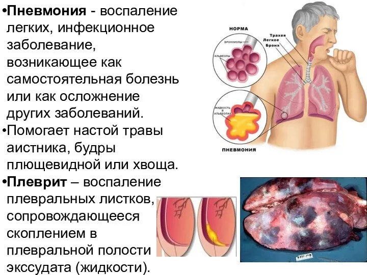 Пневмония - воспаление легких, инфекционное заболевание, возникающее как самостоятельная болезнь