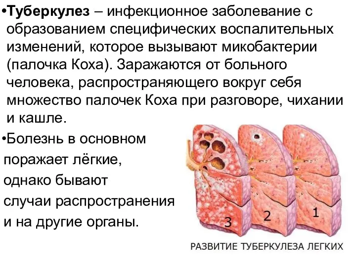 Туберкулез – инфекционное заболевание с образованием специфических воспалительных изменений, которое