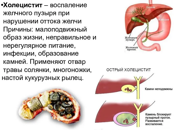 Холецистит – воспаление желчного пузыря при нарушении оттока желчи Причины: