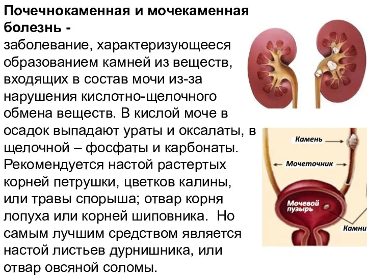 Почечнокаменная и мочекаменная болезнь - заболевание, характеризующееся образованием камней из