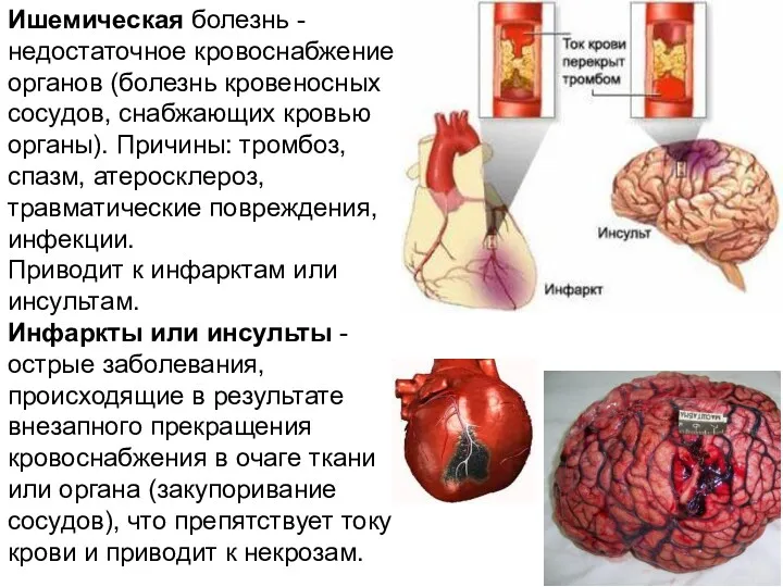 Ишемическая болезнь - недостаточное кровоснабжение органов (болезнь кровеносных сосудов, снабжающих